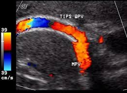 Color Doppler Mappatura (sovrapposto a immagine) velocità del flusso sanguigno in base alla frequenza media Informazioni sulla : direzione (movimento) rosso