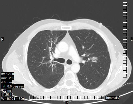 CT scan