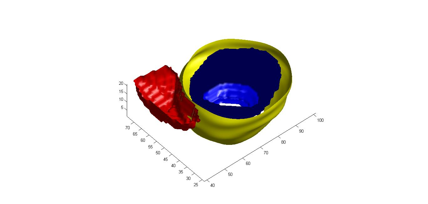 PAZIENTE 89 Fig. 4.17. rendering volumetrico di fine diastole dei due ventricoli.