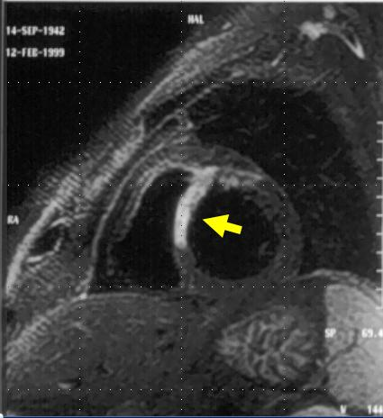 Fig 1.5: Immagine di RM di infarto miocardico antero-settale studiato in fase acuta. La freccia indica la zona infartuata. Immagine tratta da [14].