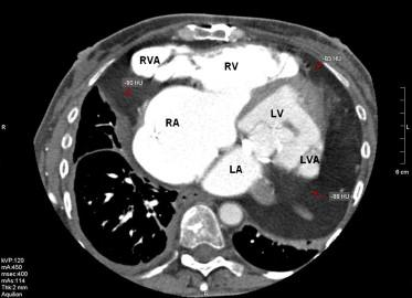 Fig. 1.6: CT elaborata di due aneurismi ventricolari. RVA: aneurisma del ventricolo destro; LVA: aneurisma del ventricolo sinistro. Immagine tratta da [52]. 1.3.