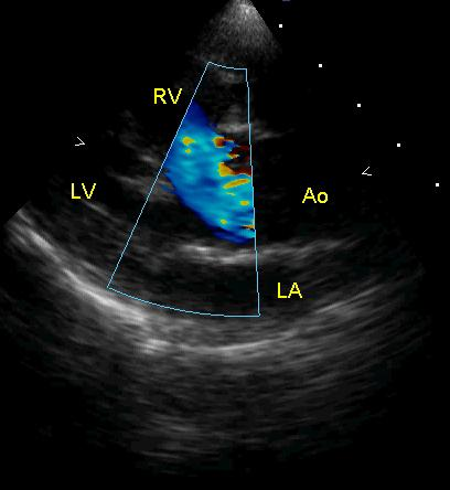 ventricoli, sopra il difetto interventricolare (aorta a cavaliere), il ventricolo destro risulta ipertrofico. Fig. 1.