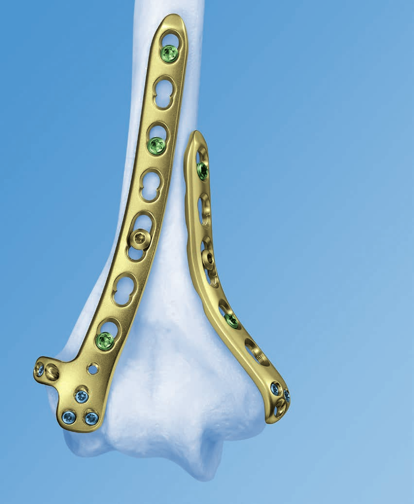 Placche distali LCP per omero. Il sistema di fissaggio anatomico per l omero distale con stabilità angolare.