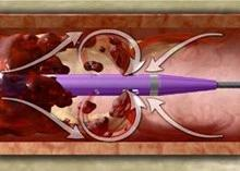 ANGIOJET Trombectomia reolitica Sfrutta l effetto Bernoulli ottenuto tramite un flusso di soluzione fisiologica + eparina sodica