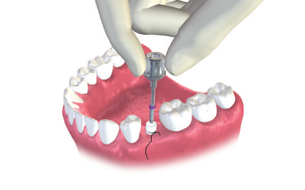 Fase 4 Montaggio Inserire la vite di fissaggio e stringere a mano. Utilizzare il cacciavite Straumann SCS. Verificare l adattamento ed eventuale gioco rotazionale o verticale.