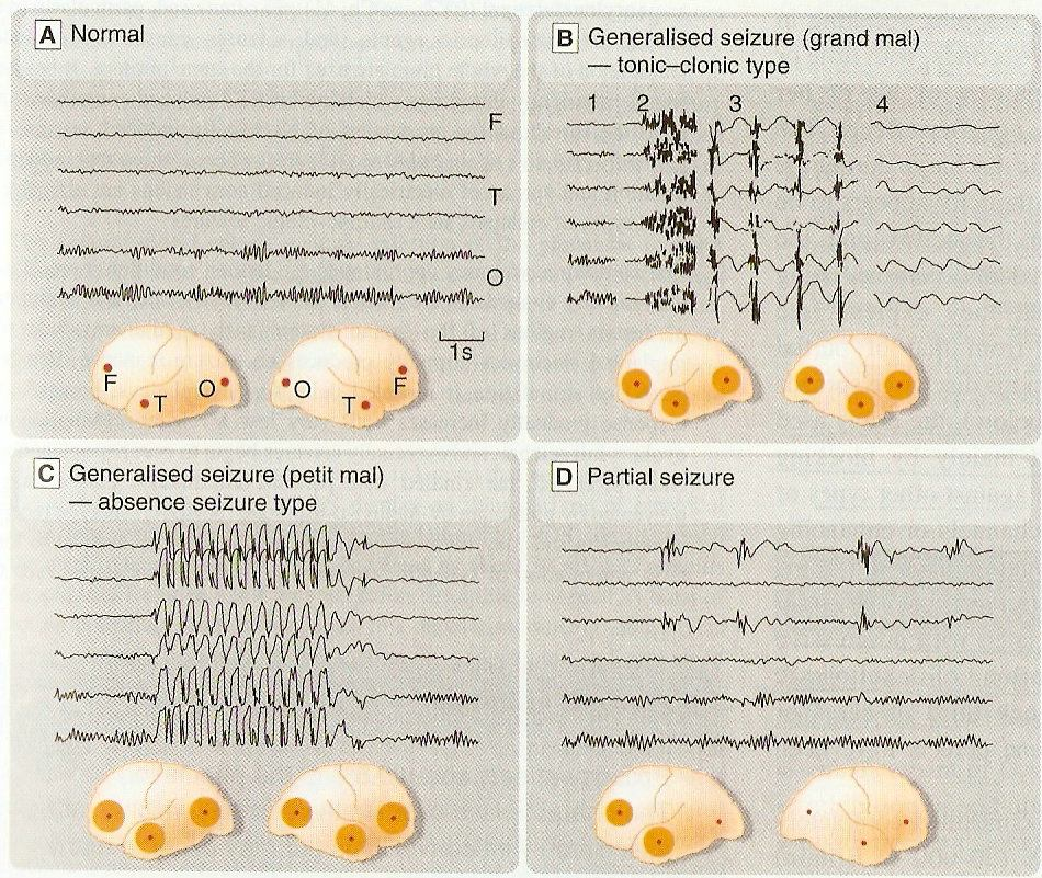 EEG nell