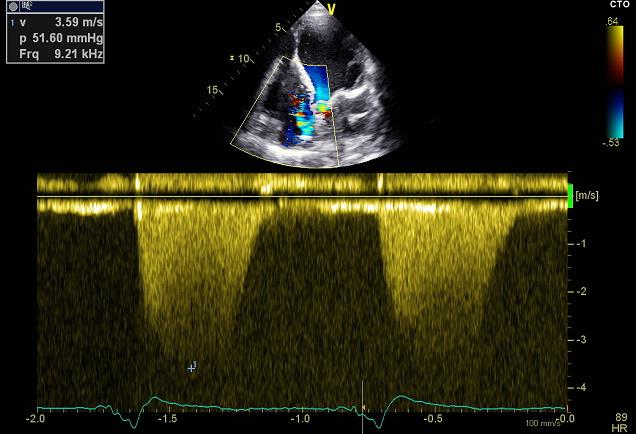 0,2 : bassa probabilità di elevate PVR