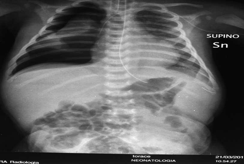 Evoluzione clinica (10) Nuova improvvisa crisi di