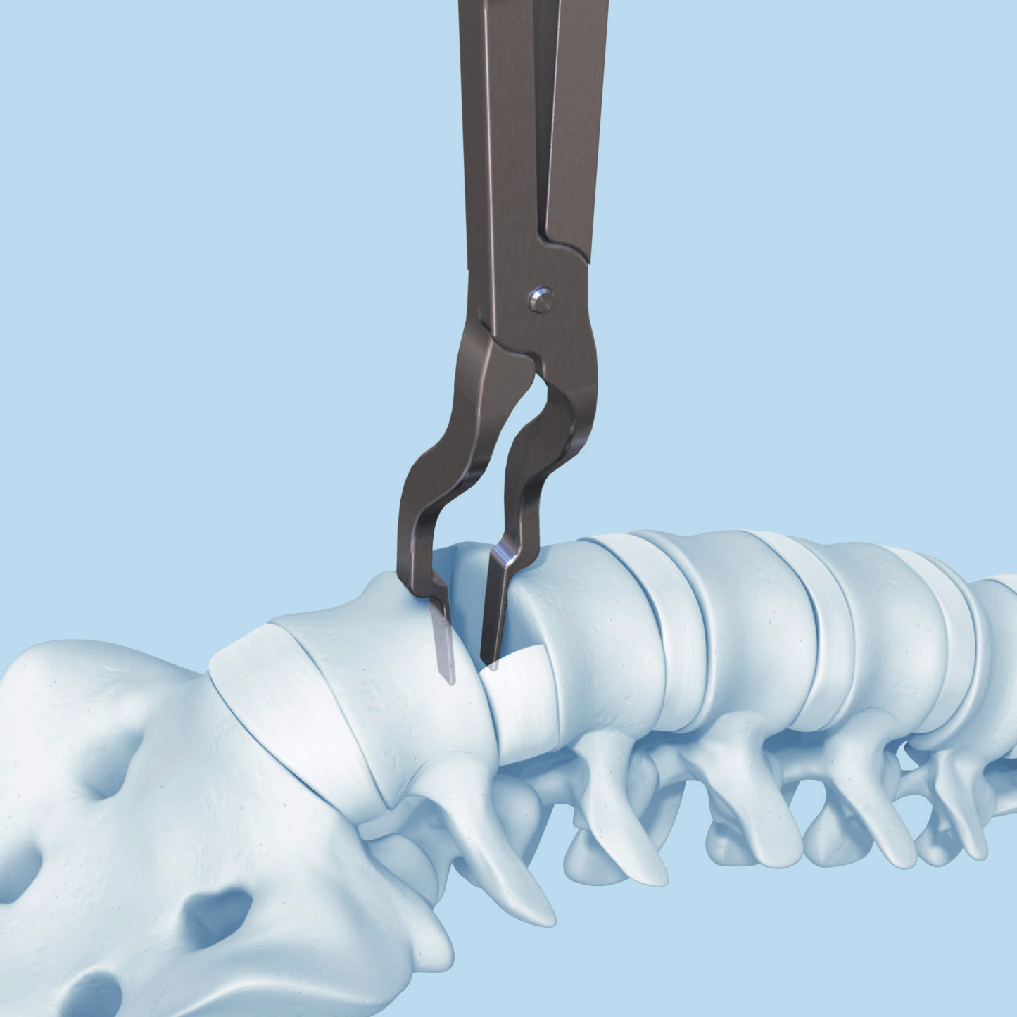 Preparazione e impianto di prova Una volta preparate le placche terminali, completare le eventuali procedure chirurgiche supplementari (cioè la rimozione di un frammento discale dal canale spinale).
