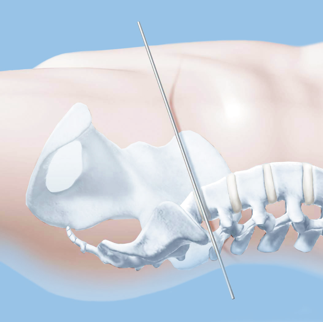 Accesso ed esposizione 1 Posizionamento del paziente Per un approccio anteriore ai livelli lombari inferiori, sistemare il paziente in posizione Trendelenburg leggermente inclinata.