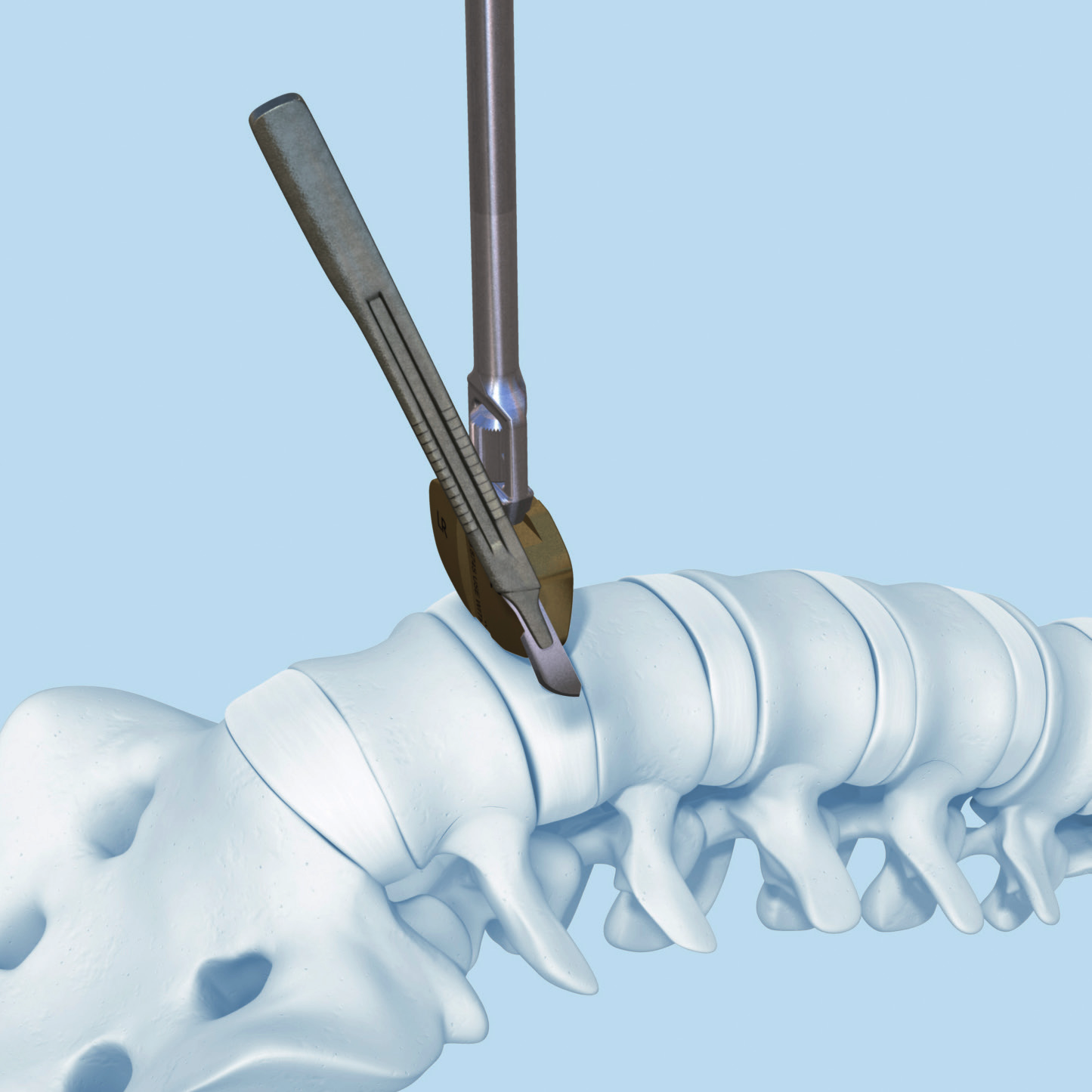 Preparazione e impianto di prova 1 Taglio della finestra anteriore Tagliare una finestra rettangolare della larghezza del SynCage-LR nel legamento longitudinale anteriore e nell annulus fibrosus.