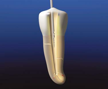 D altra parte, gli strumenti ad ultrasuoni possono solo lavorare lungo la circonferenza, portare via dentina ed esporre la porzione dell ostruzione che giace nella parte diritta del canale.