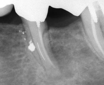 L Informatore Endodontico Vol. 5, Nr. 4 2002 7a 7b Figura 7a Fallimento endodontico del primo molare inferiore.