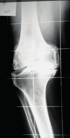 La riduzione della rima articolare è il primo segno radiologico di danno