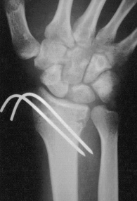 La riduzione anatomica a cielo chiuso non sempre è agevole, soprattutto se si analizzano rigorosamente tutti gli indici di misurazione radiografica.