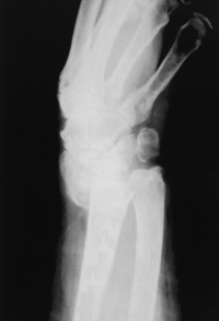 OSTEOSINTESI PERCUTANEA DELLE FRATTURE DI POLSO SECONDO CRENSHAW-MAH 189 mezzo di sintesi l eventuale evoluzione negativa di alcuni casi.