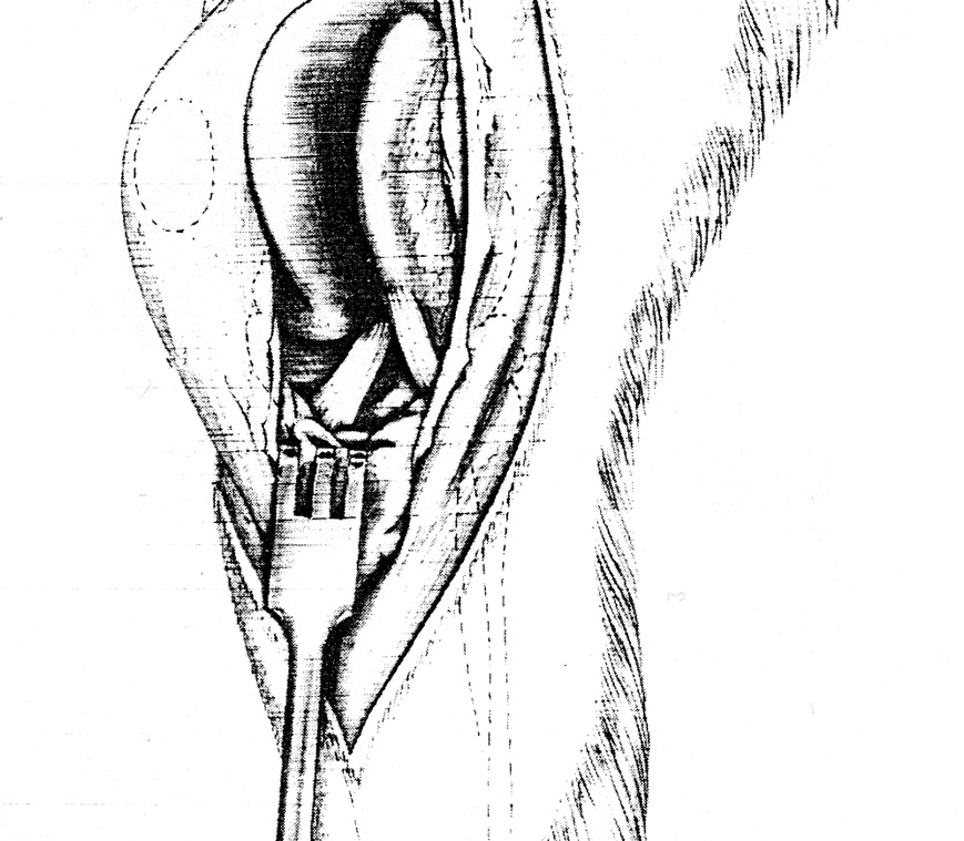 R. DEL GINOCCHIO Rottura del leg. crociato craniale leg.