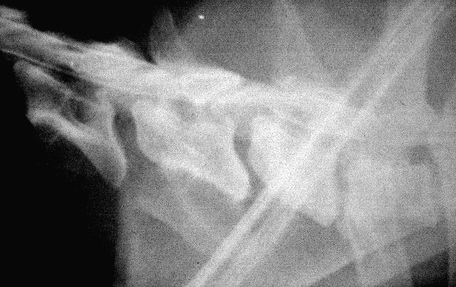 CVMM Segni radiografici: Deformazione vertebre Spazio intervertebrale