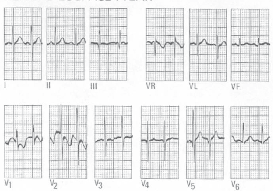 274 SAPER FARE Quaderni acp www.quaderniacp.it 6 [2016] Figura 7. Posizione delle derivazioni periferiche sul piano frontale e normale asse elettrico del cuore (adulto).