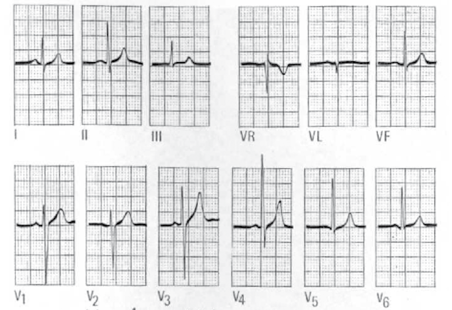 ECG normale: lattante di 7 mesi. Asse elettrico: circa +90, onda R lievemente dominante in V1, onda R dominante in V6. Onda U Non ben chiarito il suo significato.