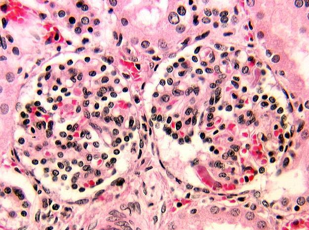 Meccanismi cellulari di ISchemia Nefrosi-necrosi tubulare acuta 3 forme