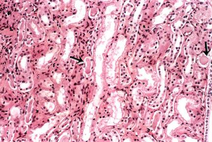 della midollare (difficile identificazione mediante biopsia) Nefropatia