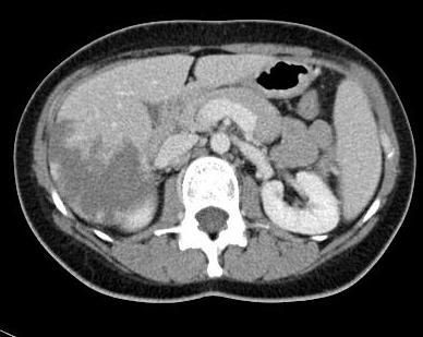 CASE STUDY 3 CL, femmina, 45 aa Riscontro US di lesioni epatiche Lesioni