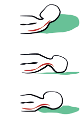 Uso corretto del rachide 9 Scelta del cuscino In caso di lombalgia o lombosciatalgia acuta, il riposo a letto è consigliabile nei primi due o tre giorni.