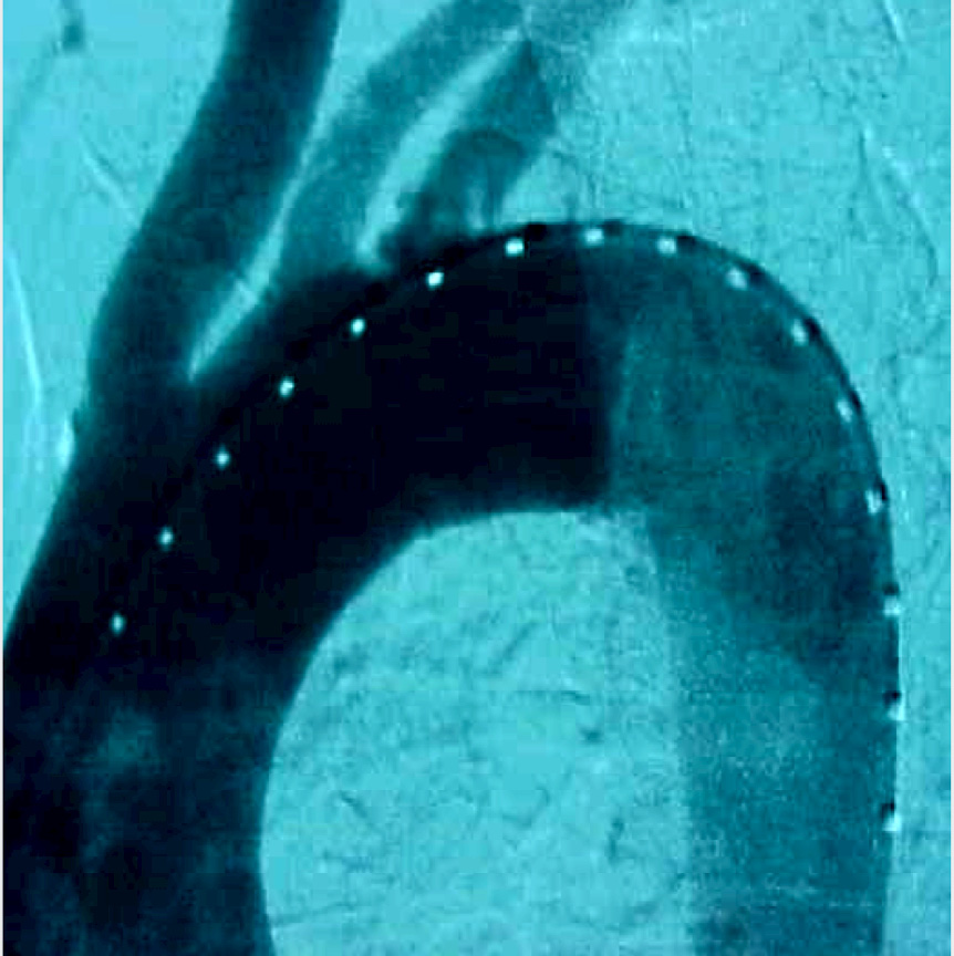 Raggio dell'arco aortico Il raggio interno