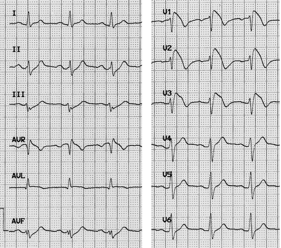 STRATIFICAZIONE DEL RISCHIO NELLA SINDROME DI BRUGADA CHIAVE DI LETTURA Ragionevoli certezze. I pazienti con sindrome di Brugada e arresto cardiaco devono ricevere un defibrillatore.