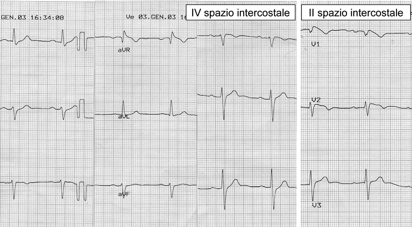 Posizionando le derivazioni precordiali V1, V2 e V3 nel secondo spazio intercostale (tracciato più a destra) si evidenzia in V1 un pattern di Brugada tipo 1.