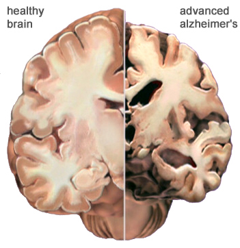Malattia di Alzheimer Più comune causa di demenza (perdita delle funzioni cognitive indipendente dallo stato di coscienza) dell anziano.