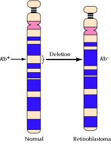 Geni oncosoppressori: Rb Delezioni di Rb nel retinoblastoma.