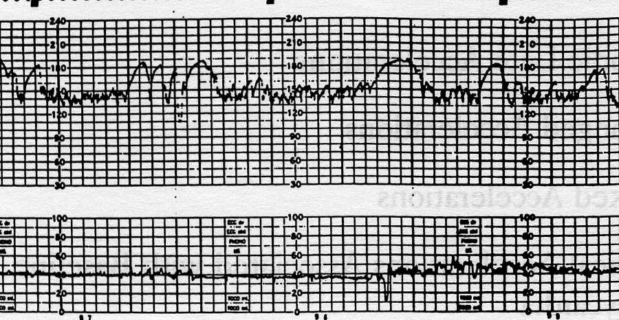 Variazioni della linea di base Accelerazioni Aumento della frequenza di almeno 15 bpm per almeno 15 sec Sporadiche Senza