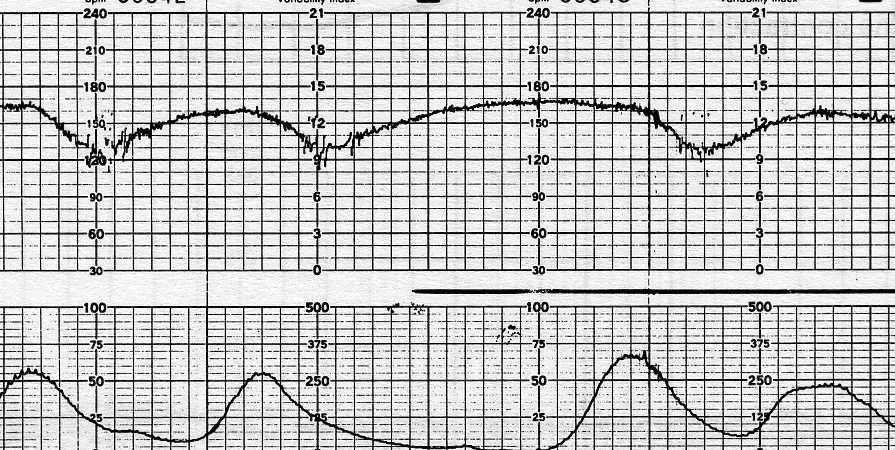 Variazioni della linea di base