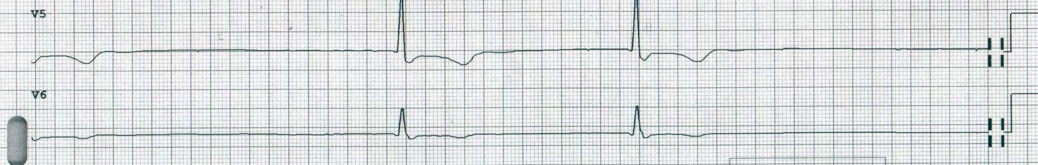 Cardiopatia aritmogena VDx (T-