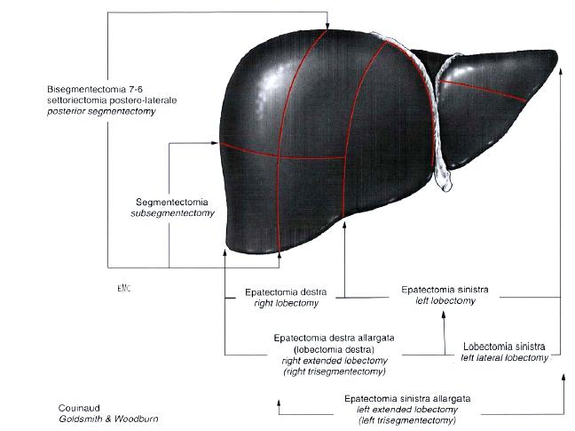 D) CLASSIFICAZIONE DELLE RESEZIONI EPATICHE (EPATECTOMIE) Epatectomia minore: epatectomia con asportazione di 3 segmenti adiacenti Epatectomia maggiore: epatectomia con asportazione di 4 segmenti