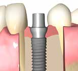 Posizioni dei margini Margini Vestibolare: Distale: Mesiale: Linguale: Suggerita: 1,0 mm subgengivale 0,75 mm subgengivale 0,75 mm subgengivale 0,5 mm subgengivale Specificare: Vestibolare: Distale: