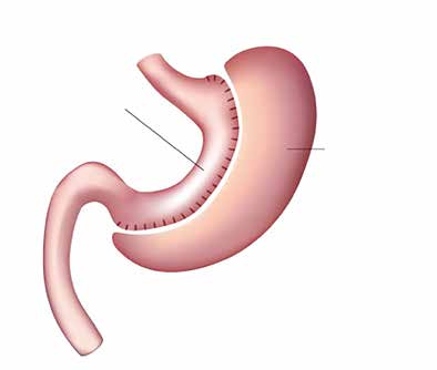 Gastrectomia verticale (nuovo stomaco) Porzione di stomaco rimossa La sleeve gastrectomy permette una perdita dal 50% al 60% del peso in eccesso.