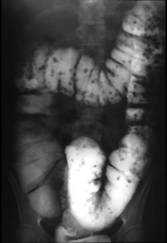 X-RAY: A single contrast study of the colon shows multiple persistent filling