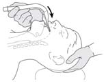 Posizionare la testa e il collo come per una normale intubazione tracheale. Figura 5. Premere la punta della maschera contro il palato duro. Figura 7.