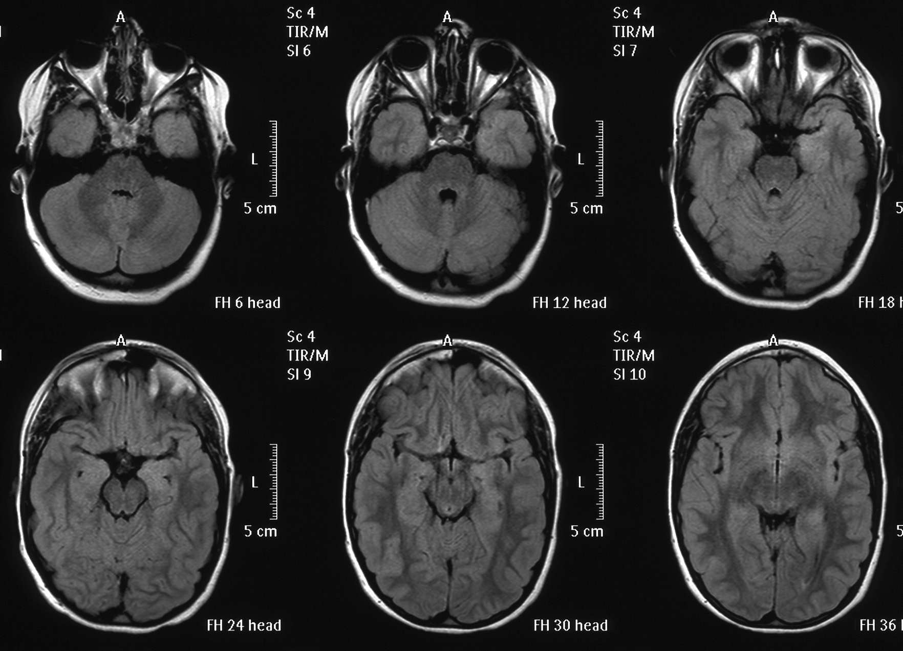 Aree del Linguaggio Area di Broca: nella zona