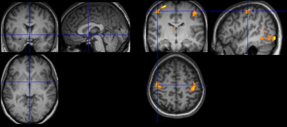 anatomia cerebrale (MRI).