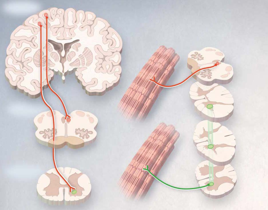 Sclerosi Laterale Amiotrofica DEFINIZIONE E VALUTAZIONE DI GRAVITA Malattia neurodegenerativa progressiva del motoneurone, che colpisce selettivamente i motoneuroni sia centrali che periferici.