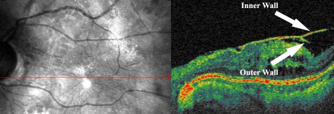 Vitreoschisi nel 50% dei fori maculari Se il livello della vitreoschisi è posteriore allo strato degli ialociti, quest ultimo si allontanerà dalla retina con la parte anteriore della corteccia
