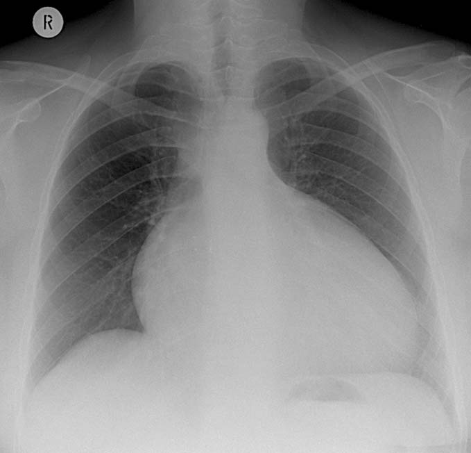 154 Cardiopatie congenite Figura 17.3 Cardiomegalia in paziente con anomalia di Ebstein della valvola tricuspide.