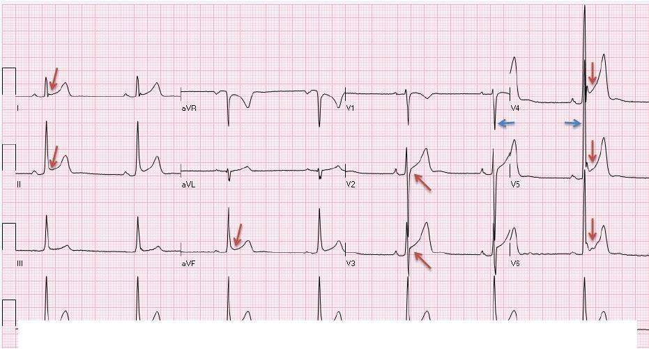 Variazioni ECG comuni nel cuore d atleta >35mm Bradicardia sinusale in un giovane calciatore di 19 anni.