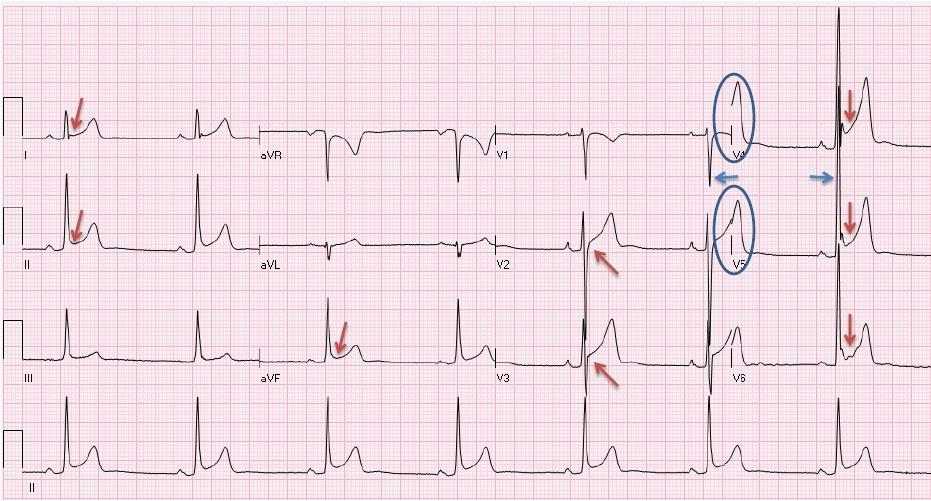 Ripolarizzazione precoce >35mm Calciatore di 20 anni asintomatico, che dimostra una ripolarizzazione precoce (punto J ed elevazione del tratto ST)