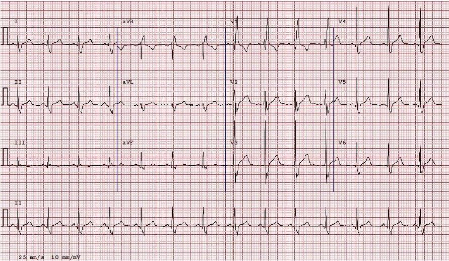 Anormale conduzione intraventricolare Ogni prolungamento del QRS 140 ms Blocco di