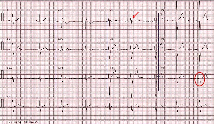 Blocco di Branca destro (BBdx) completo - Normale L ECG mostra un onda R in V1